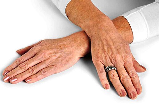 Kůže rukou se změnami souvisejícími s věkem vyžadující použití omlazovacích technik