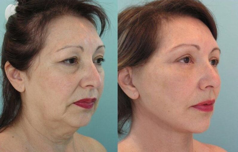 Výsledek omlazujícího zpevnění pokožky obličeje pomocí nití