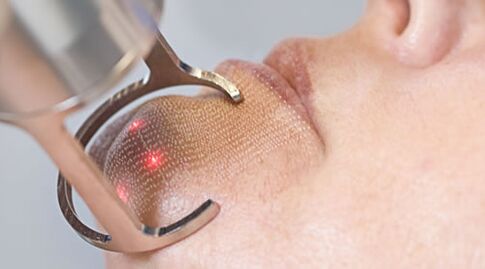 Průběh procedury pro frakční laserové omlazení pokožky obličeje