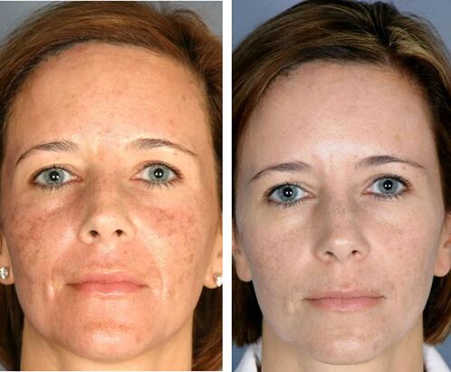 Před a po frakční termolýze obličeje