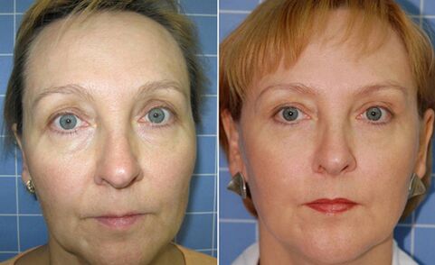 Před a po frakčním laserovém omlazení obličeje