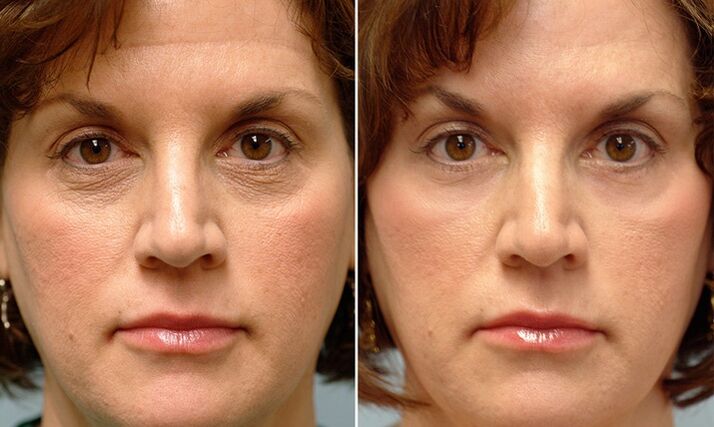 obličej před a po laserovém frakčním omlazení